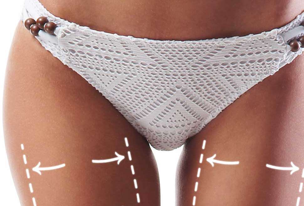 fettsuging liposkultur